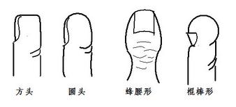 拇指较其形状分为：分头形、圆头形、蜂腰形、棍棒形、反仰形